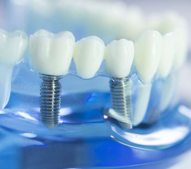 Greensboro Dental Implants
